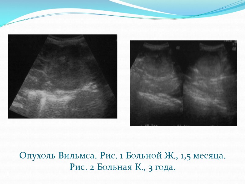 Опухоль Вильмса. Рис. 1 Больной Ж., 1,5 месяца. Рис. 2 Больная К., 3 года.
